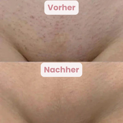 GlowTrim | Body Trimmer