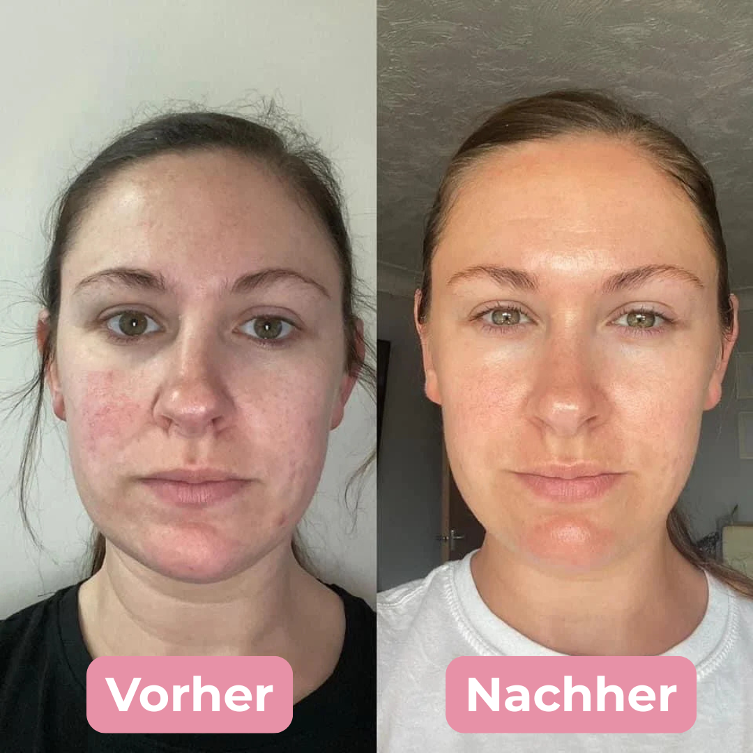 Kojic Acid Pads - Porentiefe Reinigung