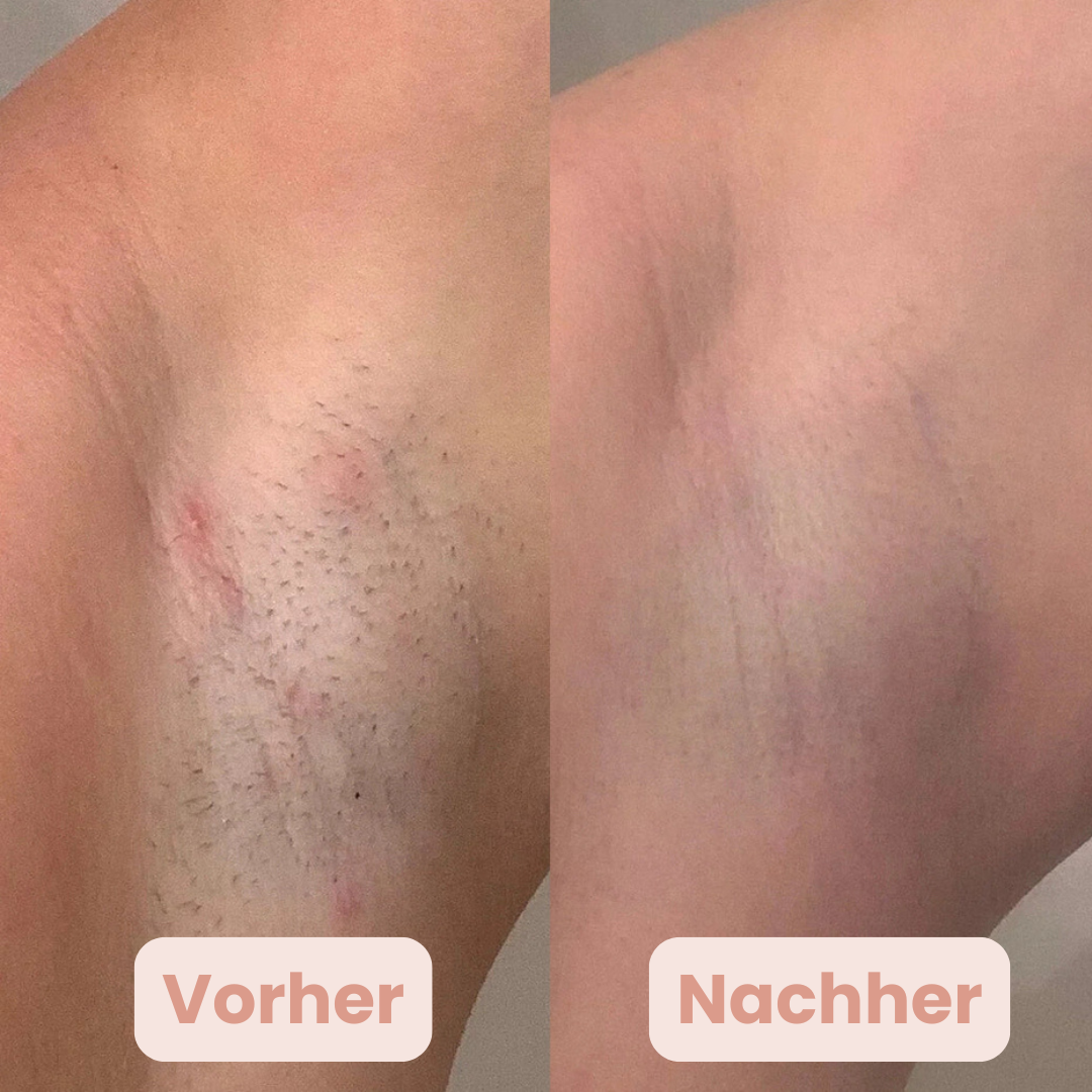 Beautix™ – Tschüss Rasierpickel.